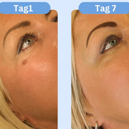 Nie wieder Hautanhängsel