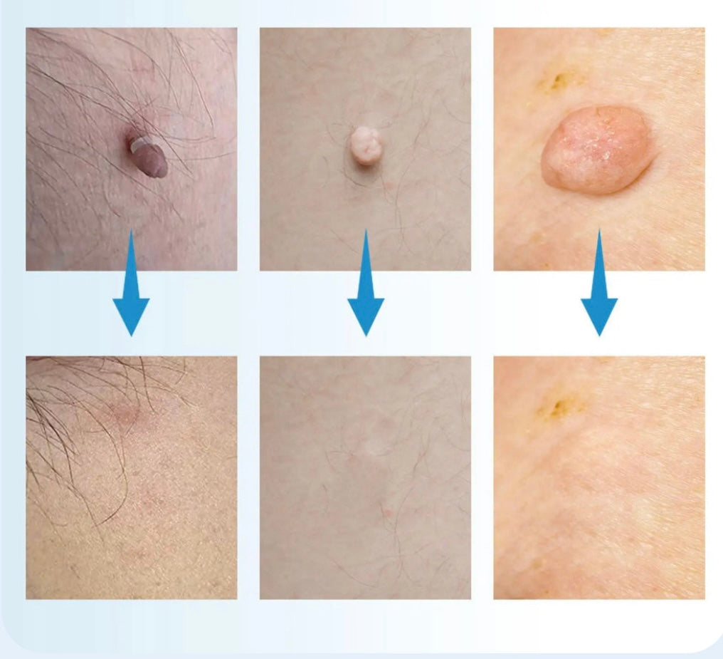 Nie wieder Hautanhängsel