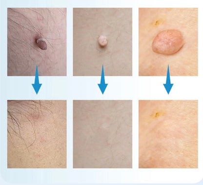 Nie wieder Hautanhängsel