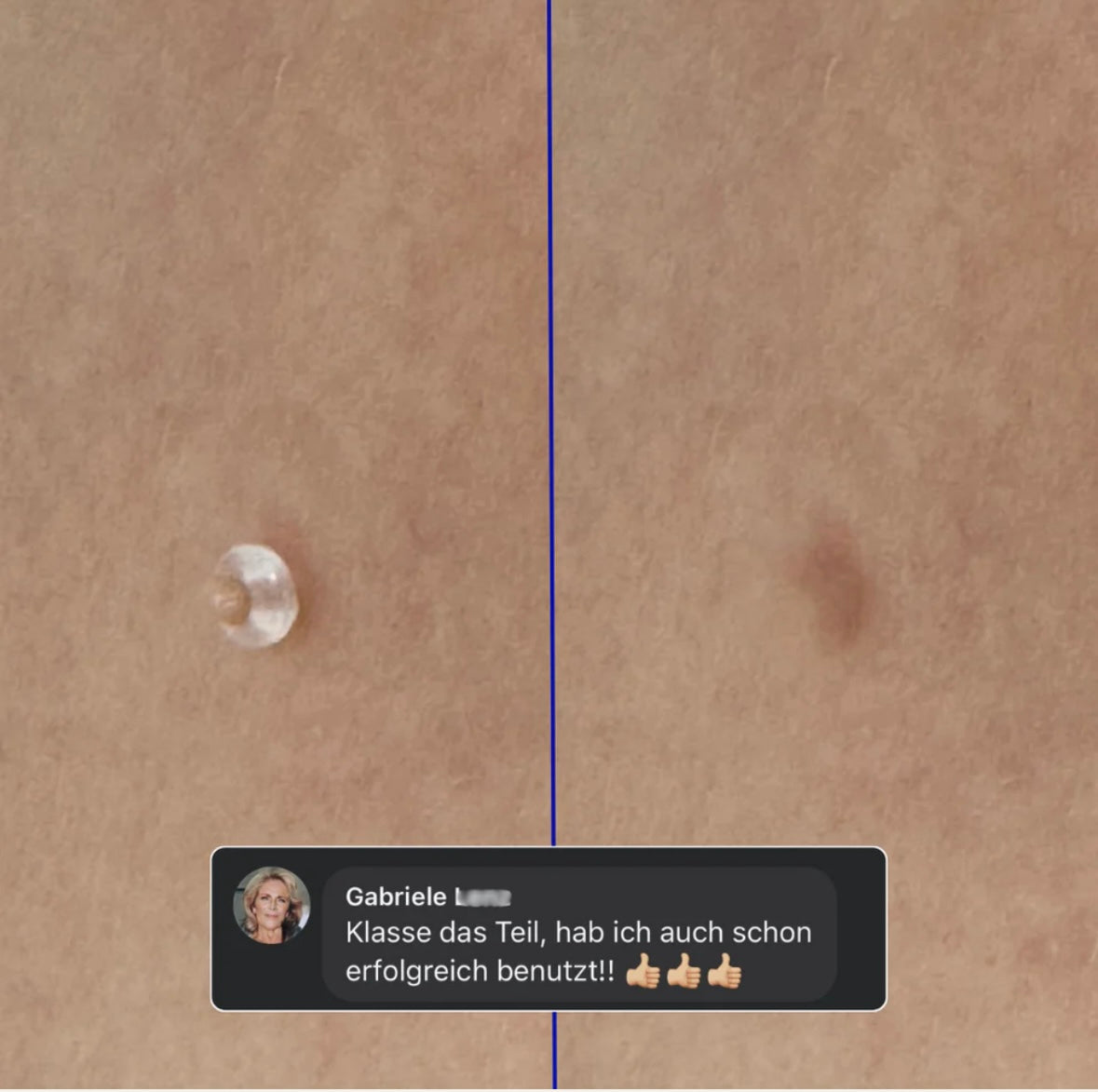 Nie wieder Hautanhängsel