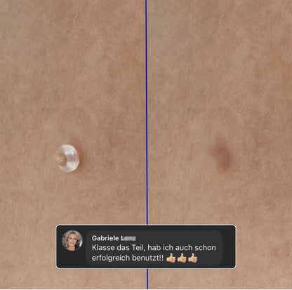 Nie wieder Hautanhängsel